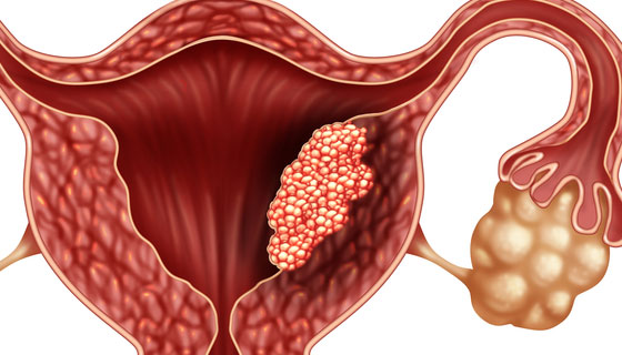 Endometrial Cancer or Uterine Cancer