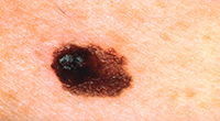 Asymmetrical Melanoma Skin Cancer Image