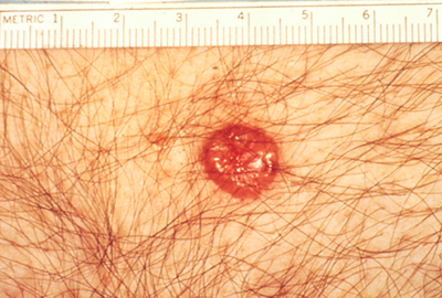 Basal Cell Carcinoma Skin Cancer Picture