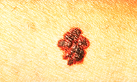 Irregular Borders Melanoma Skin Cancer Image