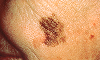 Large Diameter Skin Cancer Spot - Melanoma Image