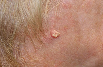 Squamous Cell Carcinoma Skin Cancer Pictures